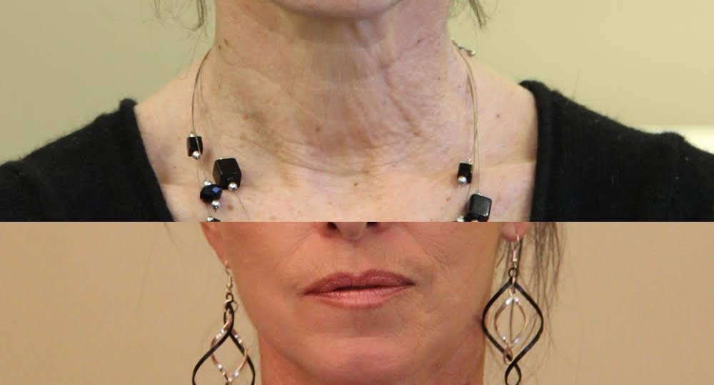 photos-chirurgie-esthetique-paris-medecine-esthetique-botox-9