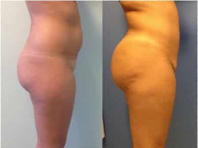 photos-chirurgie-esthetique-paris-medecine-esthetique-hyacorp-1