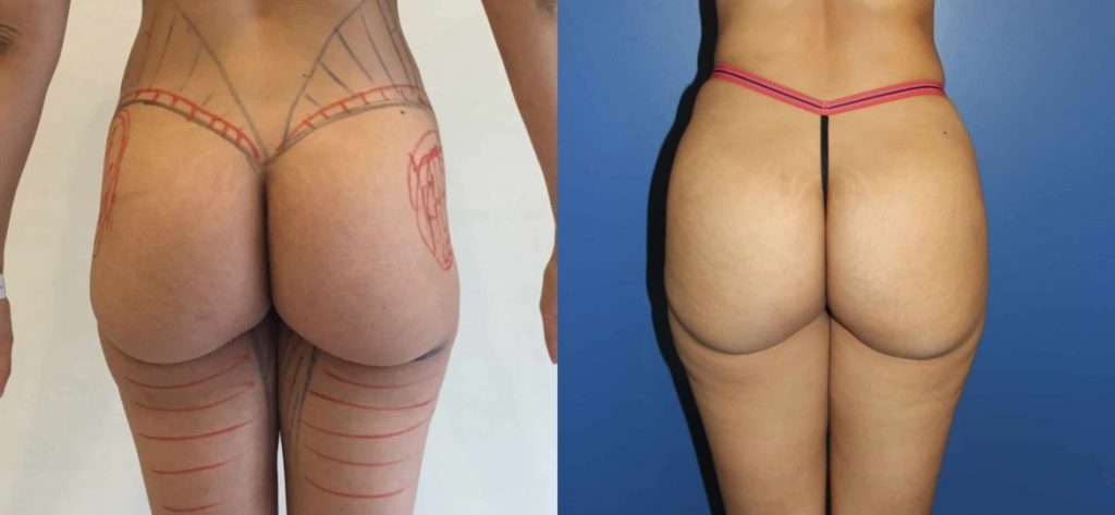 photos-chirurgie-esthetique-paris-medecine-esthetique-hyacorp-2