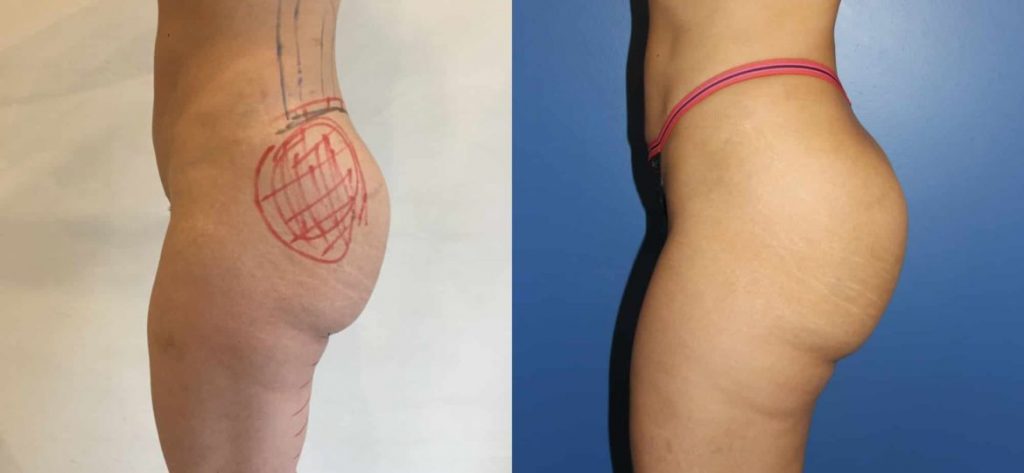 photos-chirurgie-esthetique-paris-medecine-esthetique-hyacorp-3