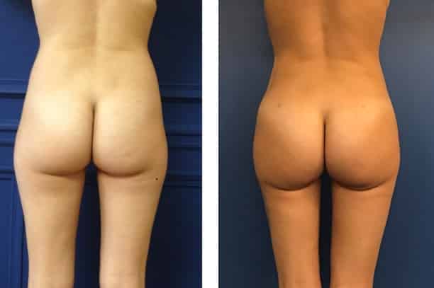 photos-chirurgie-esthetique-paris-medecine-esthetique-hyacorp-4
