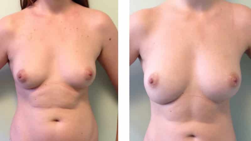 photos-chirurgie-esthetique-paris-seins-lipolifting-1