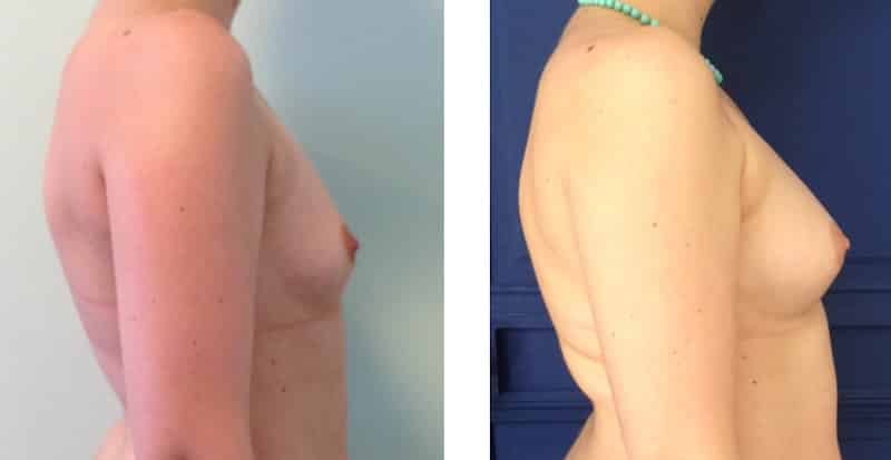 photos-chirurgie-esthetique-paris-seins-lipolifting-2