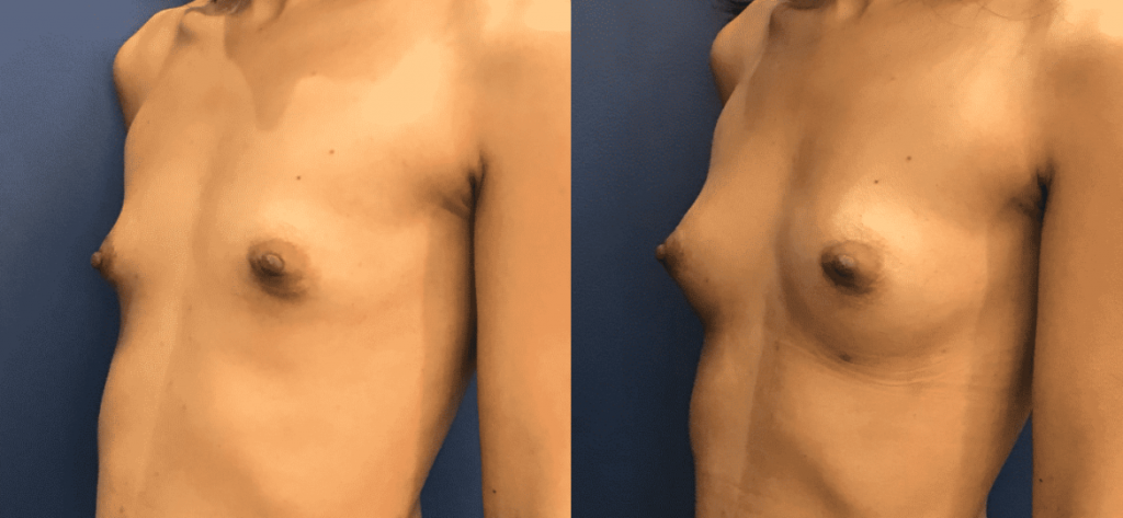 photos-chirurgie-esthetique-paris-seins-lipolifting-3