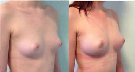 photos-chirurgie-esthetique-paris-seins-lipolifting-4
