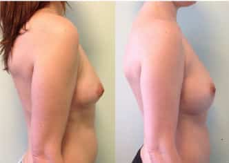 photos-chirurgie-esthetique-paris-seins-lipolifting-5