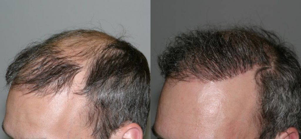 photos-chirurgie-esthetique-paris-visage-cheveux-1