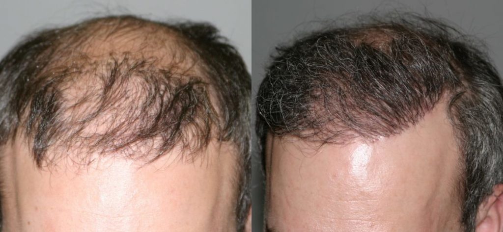 photos-chirurgie-esthetique-paris-visage-cheveux-2