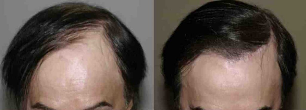 photos-chirurgie-esthetique-paris-visage-cheveux-3-1
