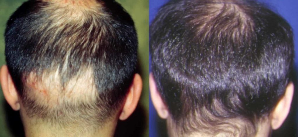 photos-chirurgie-esthetique-paris-visage-cheveux-4