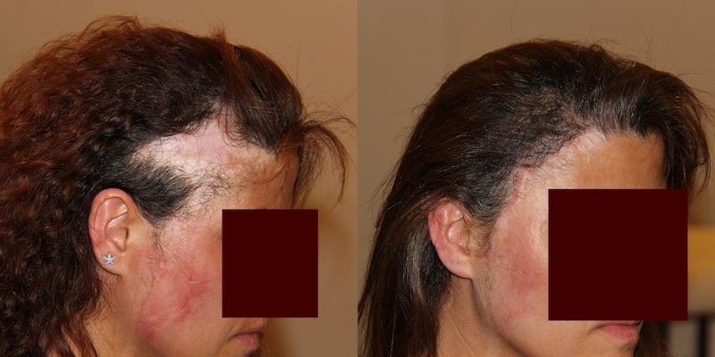 photos-chirurgie-esthetique-paris-visage-cheveux-5
