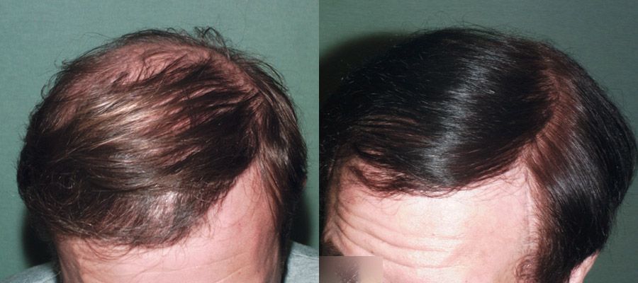 photos-chirurgie-esthetique-paris-visage-cheveux-6