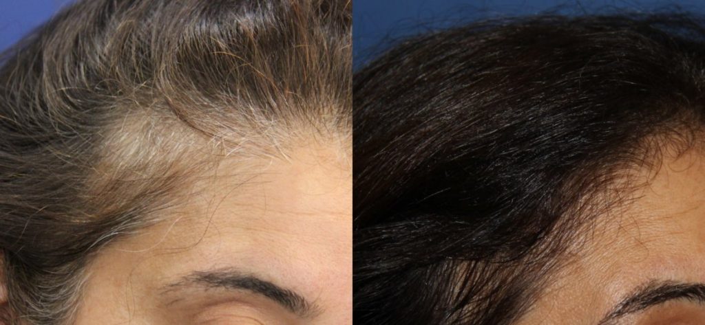 photos-chirurgie-esthetique-paris-visage-cheveux-mesotherapie-2