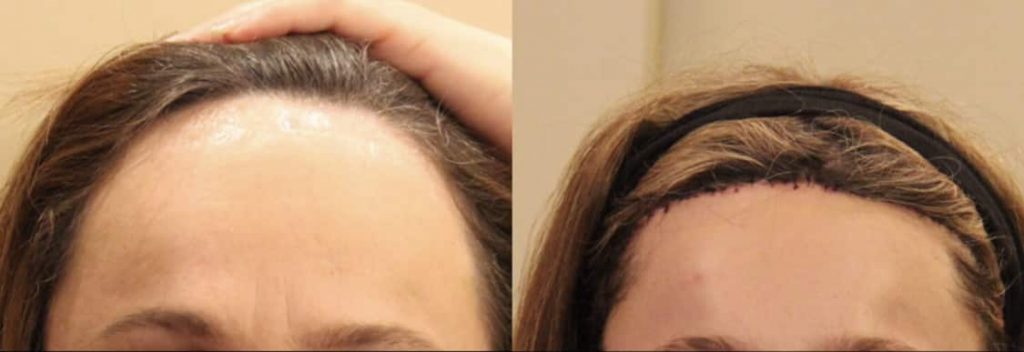photos-chirurgie-esthetique-paris-visage-cheveux-reduction-hauteur-front