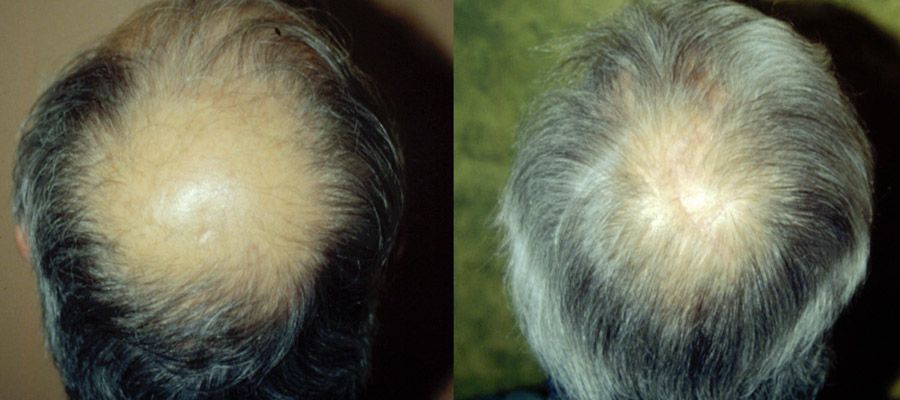 photos-chirurgie-esthetique-paris-visage-cheveux-reduction-tonsure-1