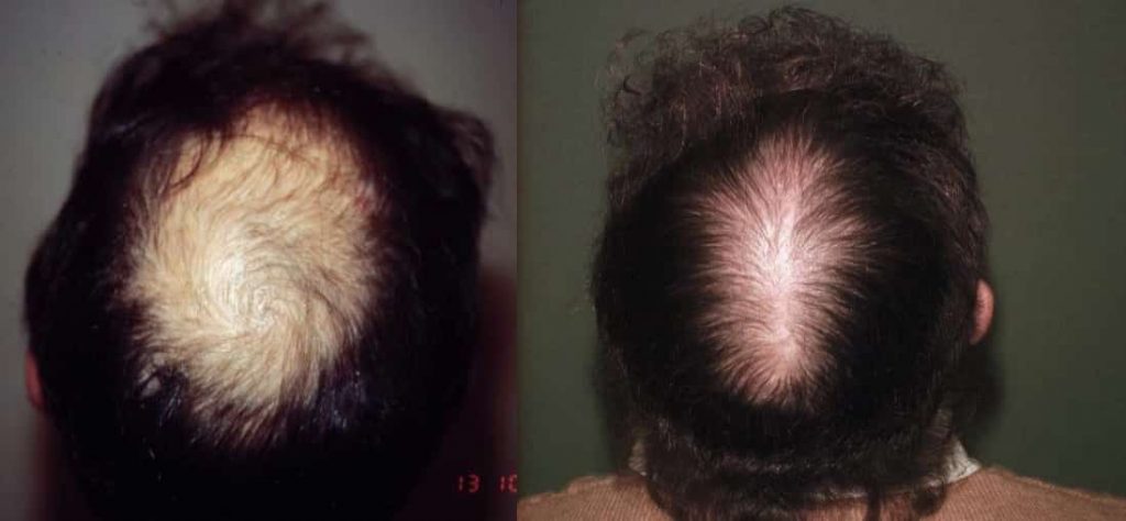 photos-chirurgie-esthetique-paris-visage-cheveux-reduction-tonsure-2