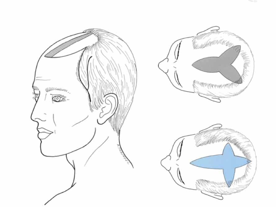 photos-chirurgie-esthetique-paris-visage-cheveux-reduction-tonsure-3