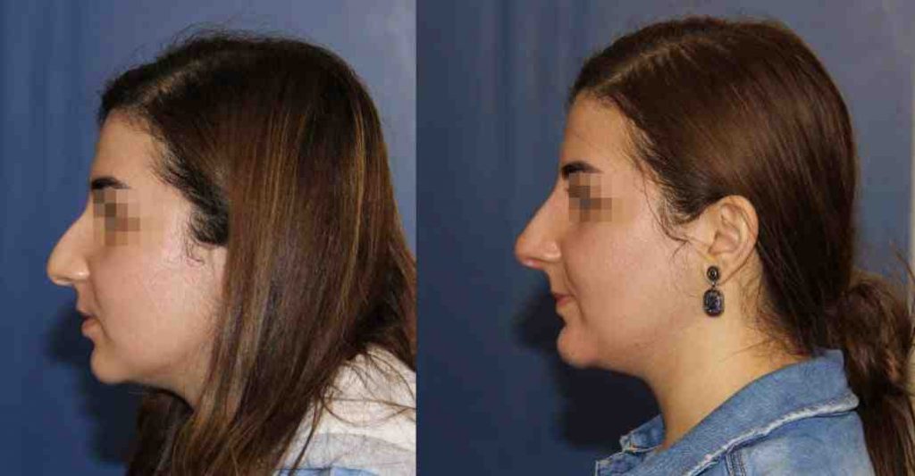 photos-chirurgie-esthetique-paris-visage-rhinoplastie-1