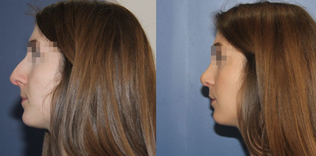 photos-chirurgie-esthetique-paris-visage-rhinoplastie-10