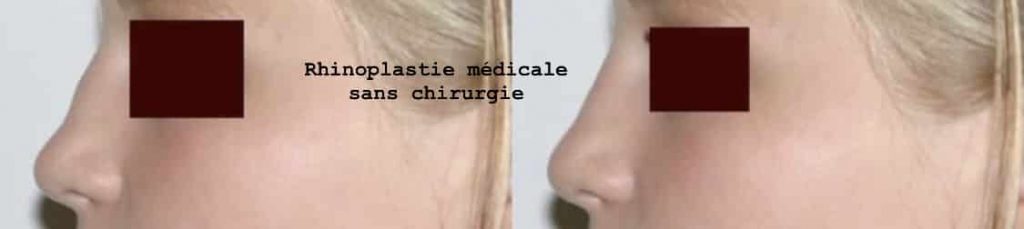 photos-chirurgie-esthetique-paris-visage-rhinoplastie-2
