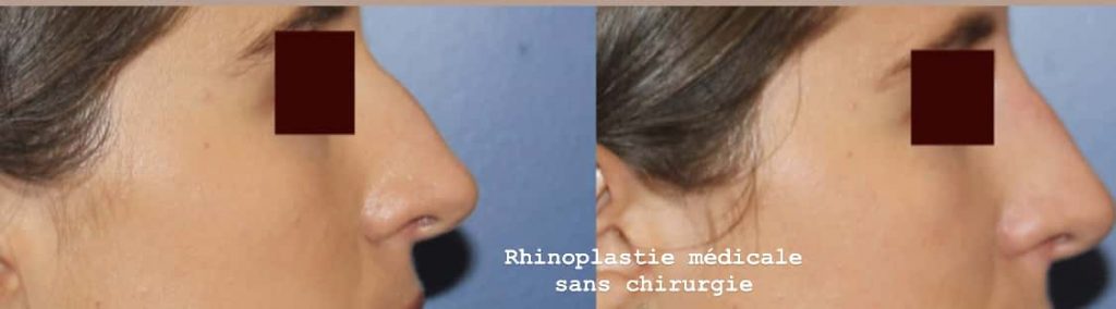 photos-chirurgie-esthetique-paris-visage-rhinoplastie-3