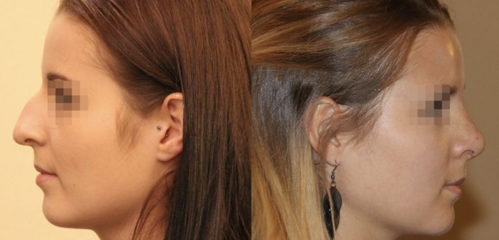 photos-chirurgie-esthetique-paris-visage-rhinoplastie-4