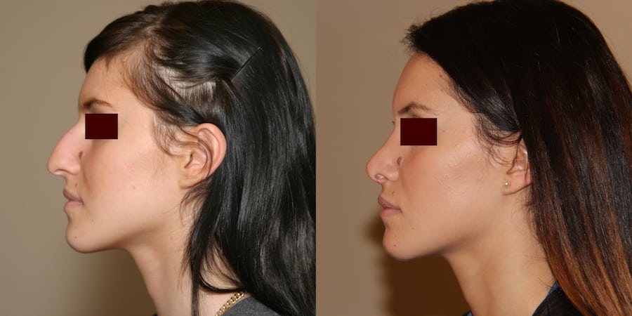 photos-chirurgie-esthetique-paris-visage-rhinoplastie-5