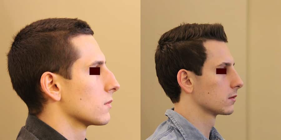 photos-chirurgie-esthetique-paris-visage-rhinoplastie-6
