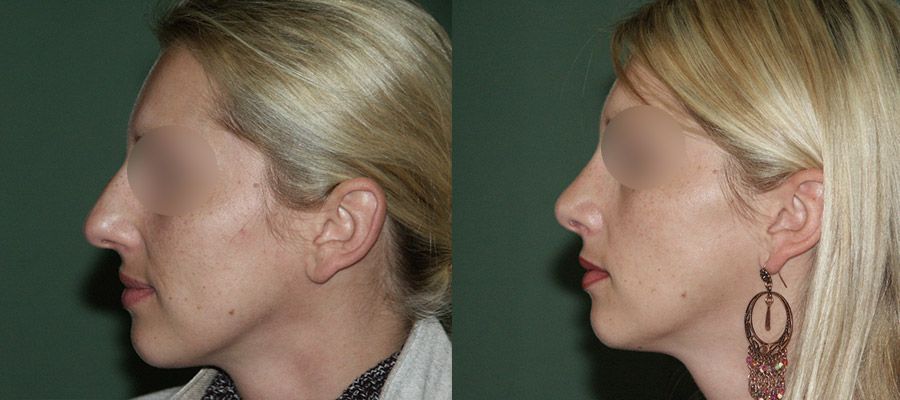 photos-chirurgie-esthetique-paris-visage-rhinoplastie-7
