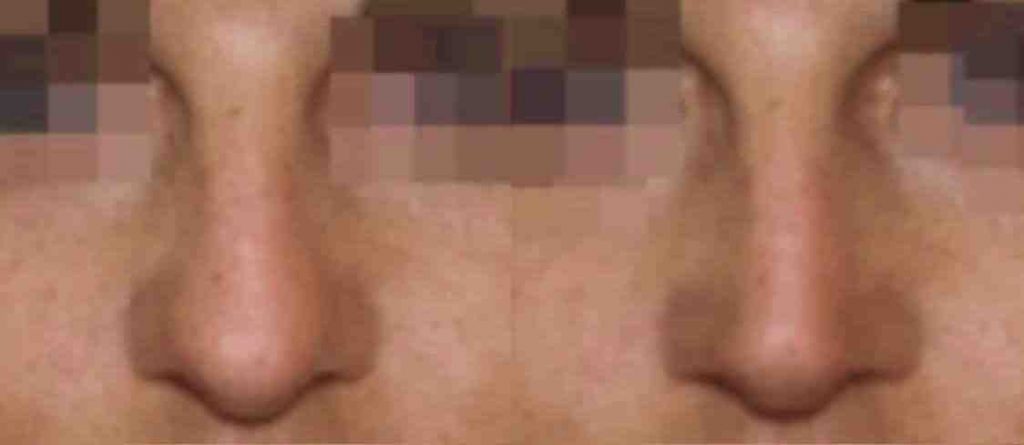 photos-chirurgie-esthetique-paris-visage-rhinoplastie-8