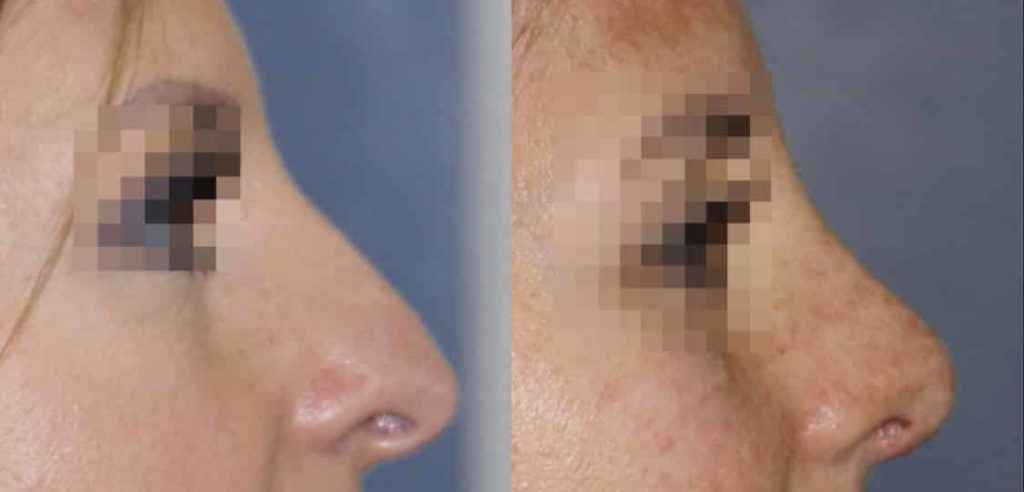 photos-chirurgie-esthetique-paris-visage-rhinoplastie-9