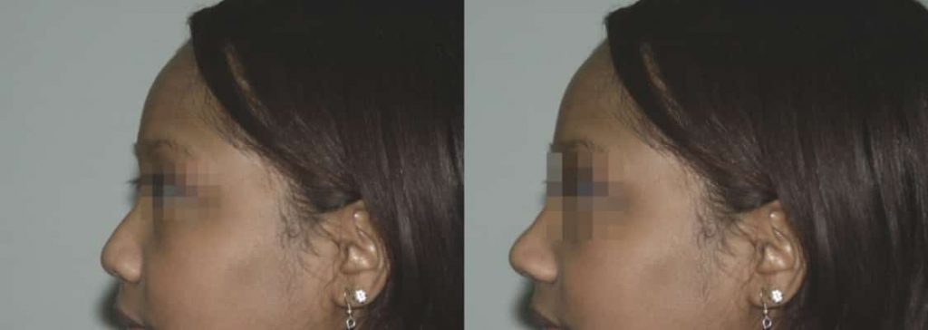 photos-chirurgie-esthetique-paris-visage-rhinoplastie-ethnique-1