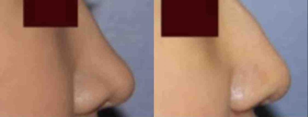 photos-chirurgie-esthetique-paris-visage-rhinoplastie-ethnique-2