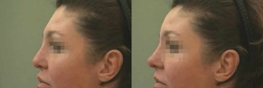 photos-chirurgie-esthetique-paris-visage-rhinoplastie-ethnique-3