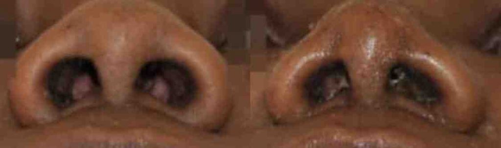 photos-chirurgie-esthetique-paris-visage-rhinoplastie-ethnique-4