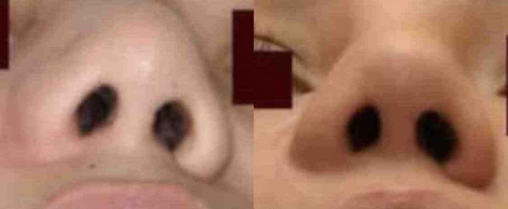 photos-chirurgie-esthetique-paris-visage-rhinoplastie-reconstruction-du-nez-1