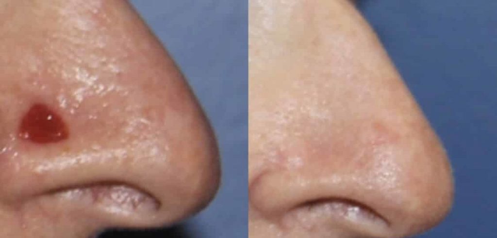 photos-chirurgie-esthetique-paris-visage-rhinoplastie-reconstruction-du-nez-2