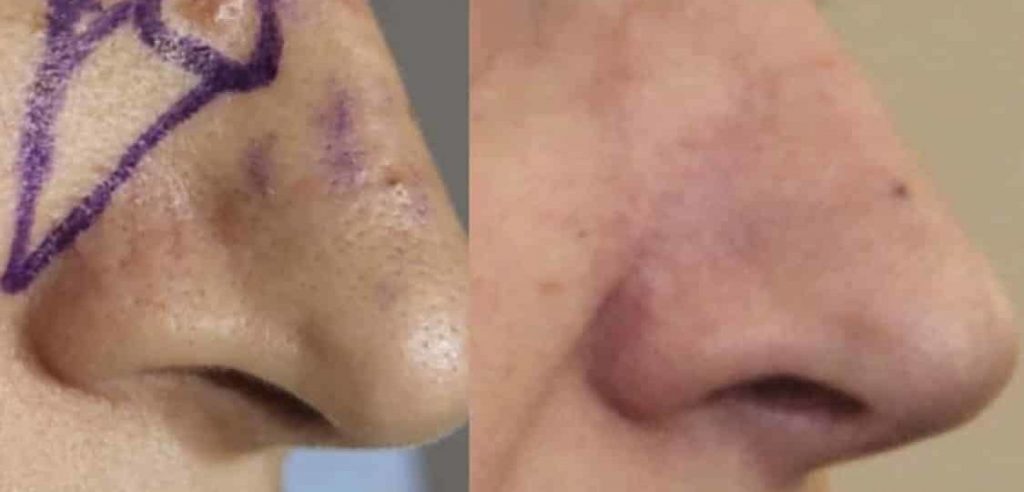 photos-chirurgie-esthetique-paris-visage-rhinoplastie-reconstruction-du-nez-3
