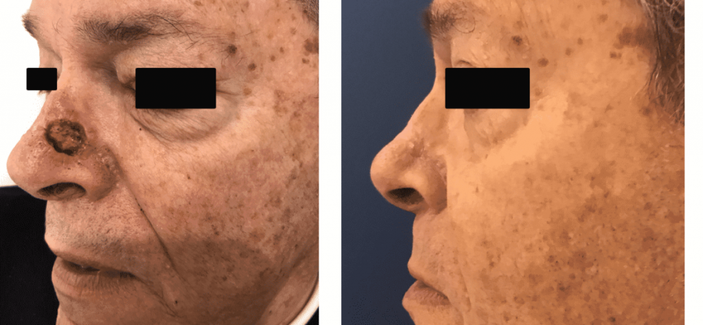 photos-chirurgie-esthetique-paris-visage-rhinoplastie-reconstruction-du-nez-4
