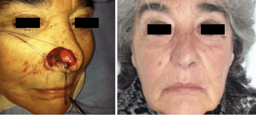 photos-chirurgie-esthetique-paris-visage-rhinoplastie-reconstruction-du-nez-5