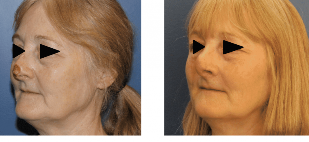 photos-chirurgie-esthetique-paris-visage-rhinoplastie-reconstruction-du-nez-6
