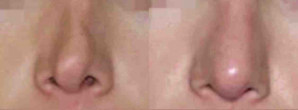 photos-chirurgie-esthetique-paris-visage-rhinoplastie-secondaire-1