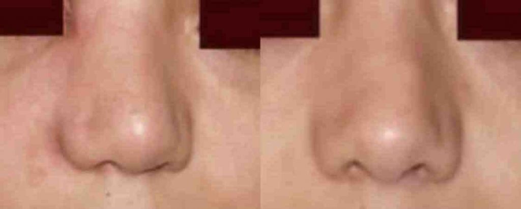 photos-chirurgie-esthetique-paris-visage-rhinoplastie-secondaire-2