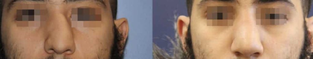 photos-chirurgie-esthetique-paris-visage-rhinoplastie-septoplastie