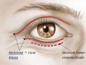 blepharoplastie