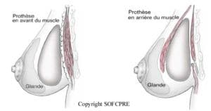 protheses mammaires paris