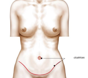 The Cosmetic Lane on X: An extreme case of Umbilical Hernia & severe  Diastasis Recti ✨ She's only 6 weeks post op  / X