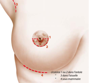 cicatrice augmentation mammaire