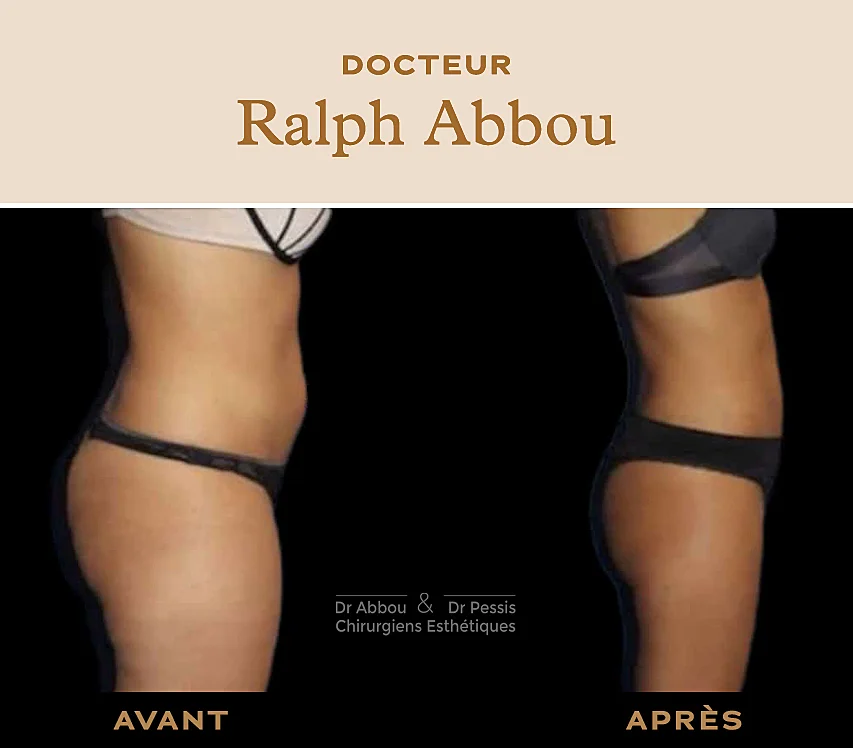 Belly liposuction in Paris. Dr ABBOU and Dr PESS