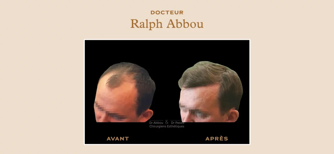 Greffe de cheveux à paris